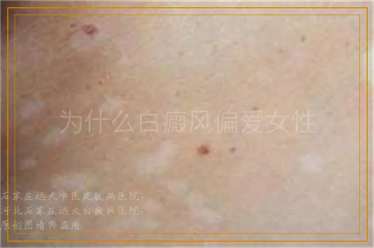 为什么白癜风偏爱女性