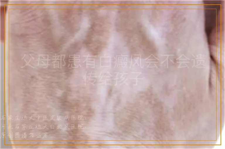 父母都患有白癜风会不会遗传给孩子
