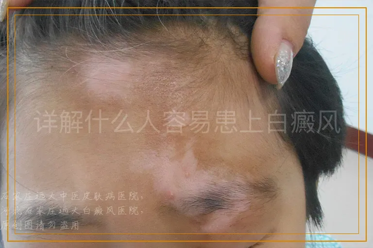 详解什么人容易患上白癜风