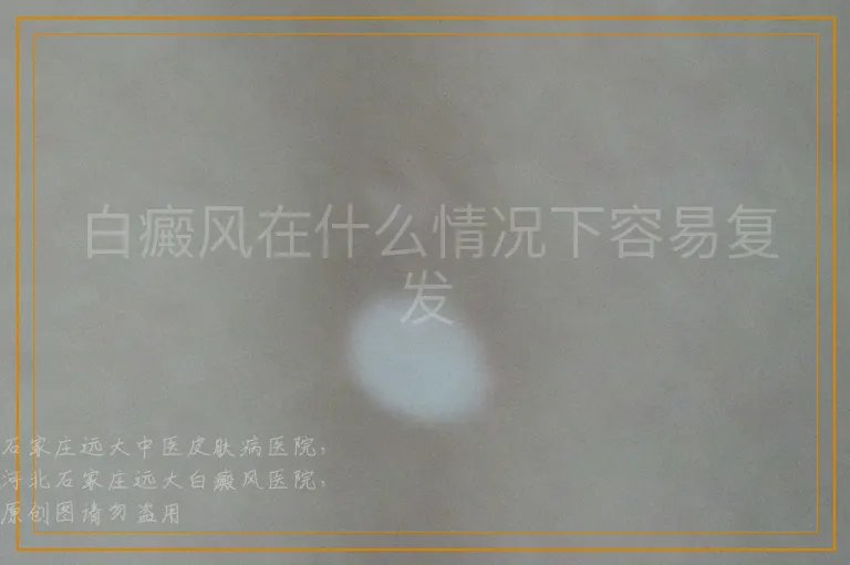 白癜风在什么情况下容易复发