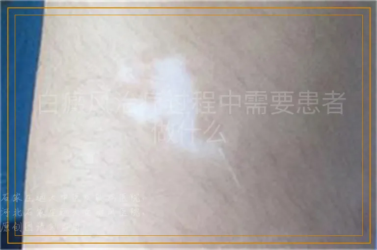 白癜风治疗过程中需要患者做什么