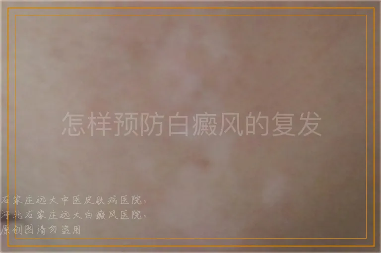 怎样预防白癜风的复发