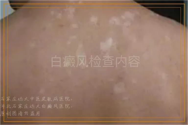 白癜风检查内容
