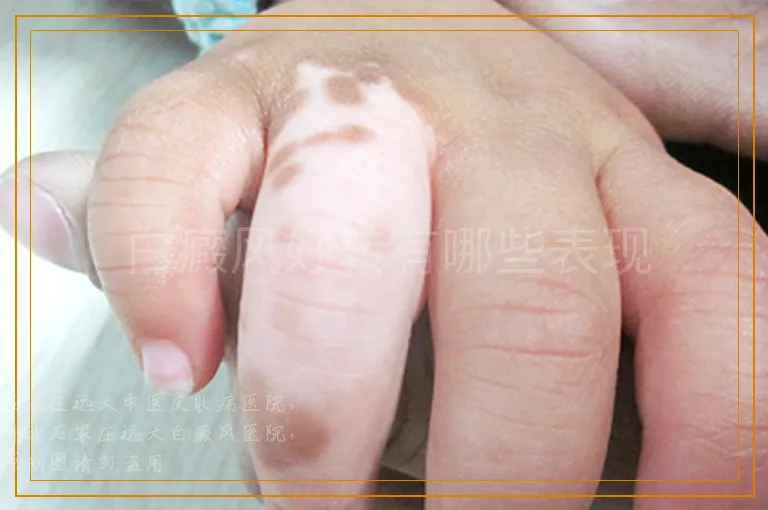 白癜风好转有哪些表现