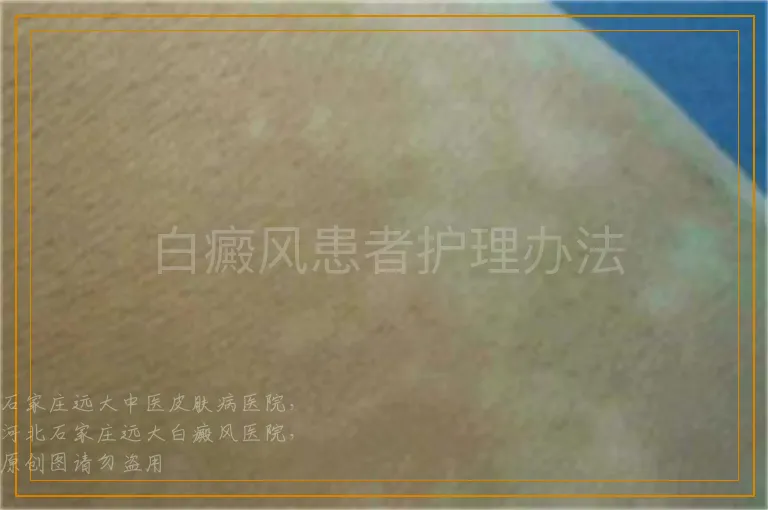 白癜风患者护理办法