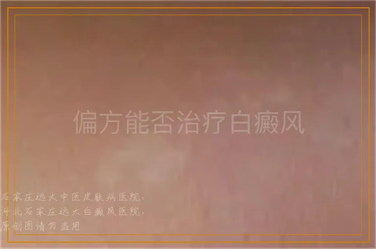 偏方能否治疗白癜风
