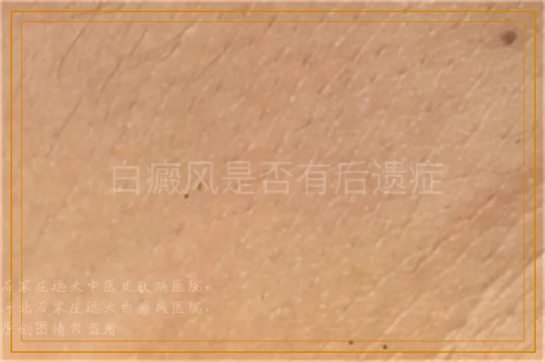 白癜风是否有后遗症