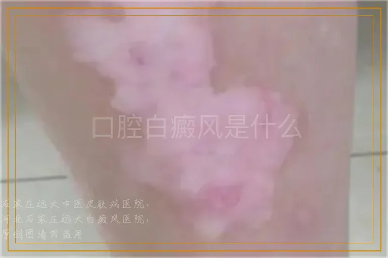 口腔白癜风是什么
