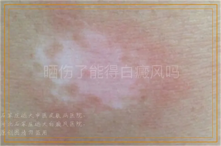 晒伤了能得白癜风吗