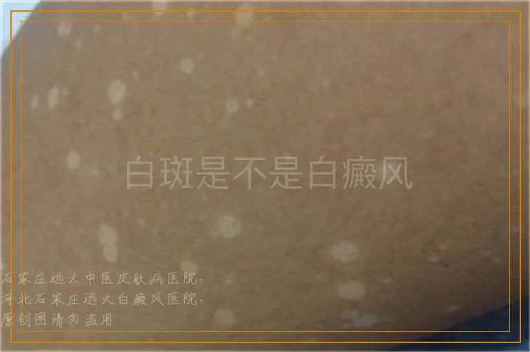 白斑是不是白癜风