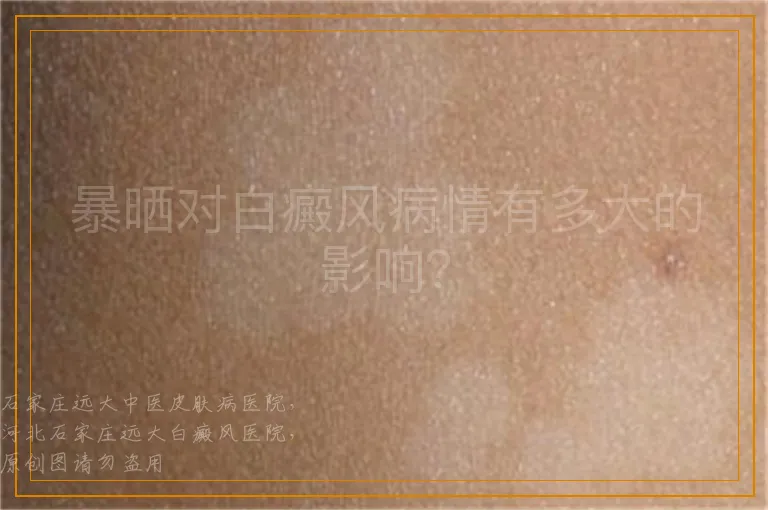 暴晒对白癜风病情有多大的影响？