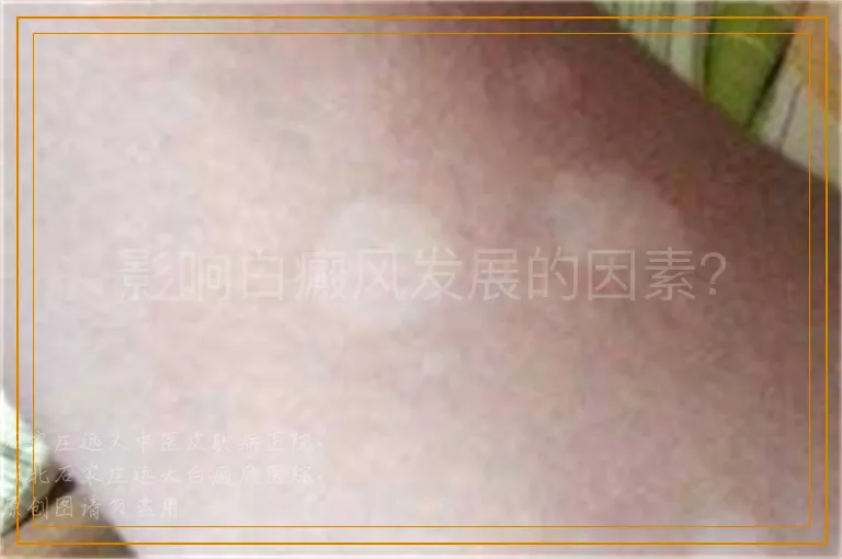 影响白癜风发展的因素？