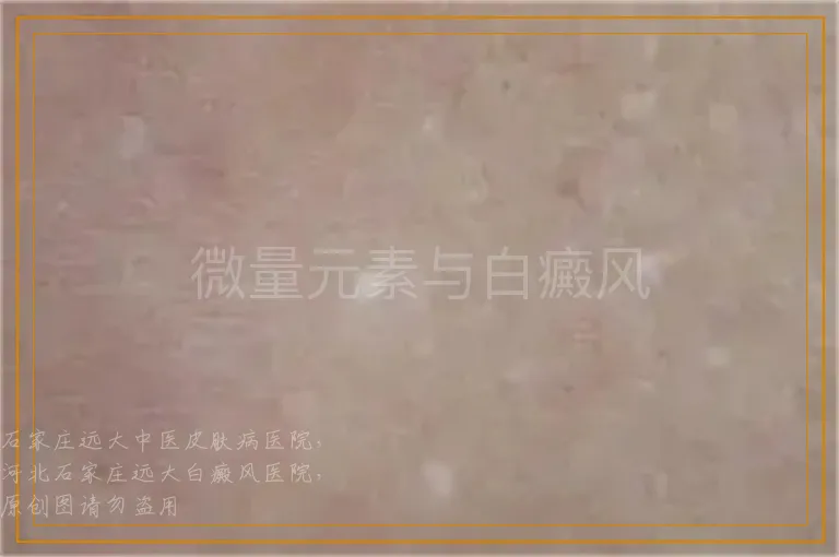 微量元素与白癜风