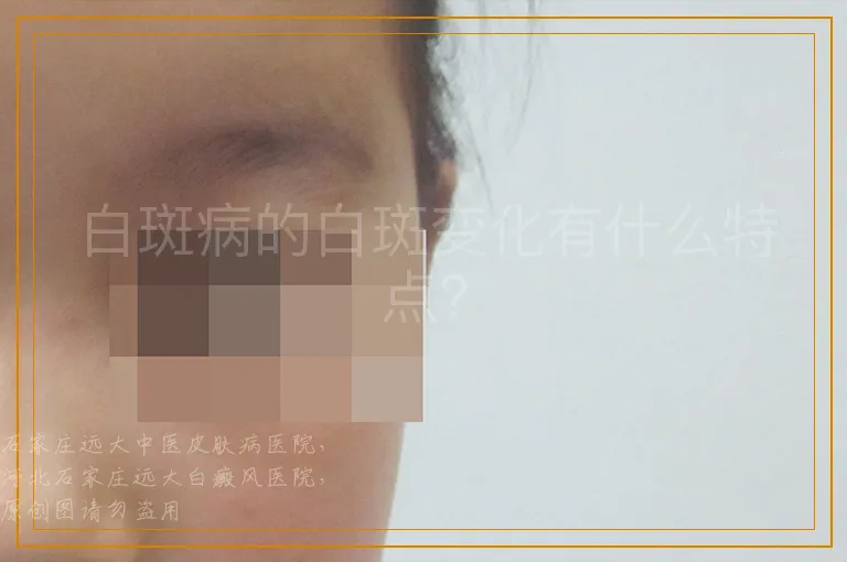 白斑病的白斑变化有什么特点？