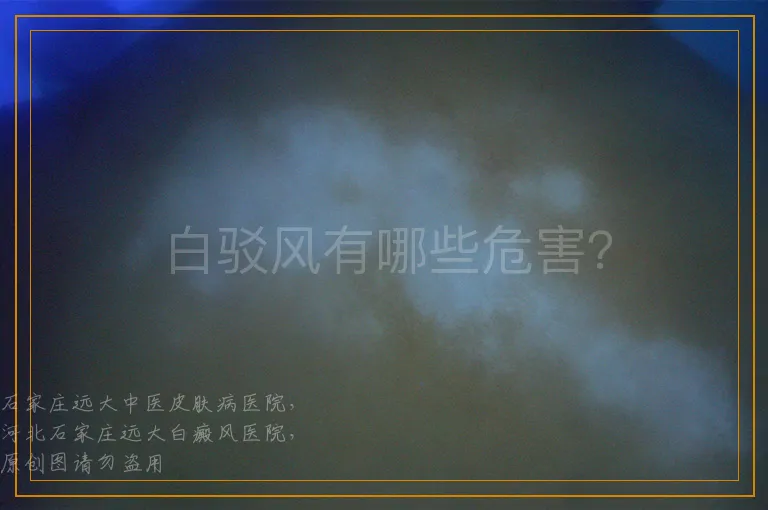 白驳风有哪些危害？