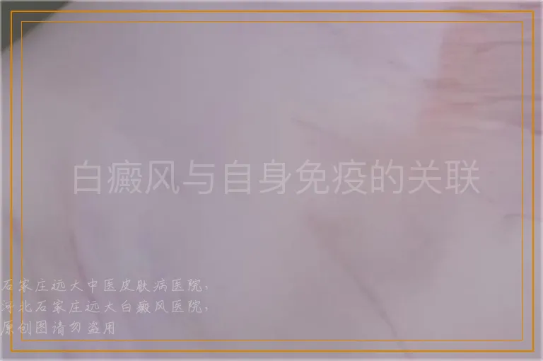白癜风与自身免疫的关联
