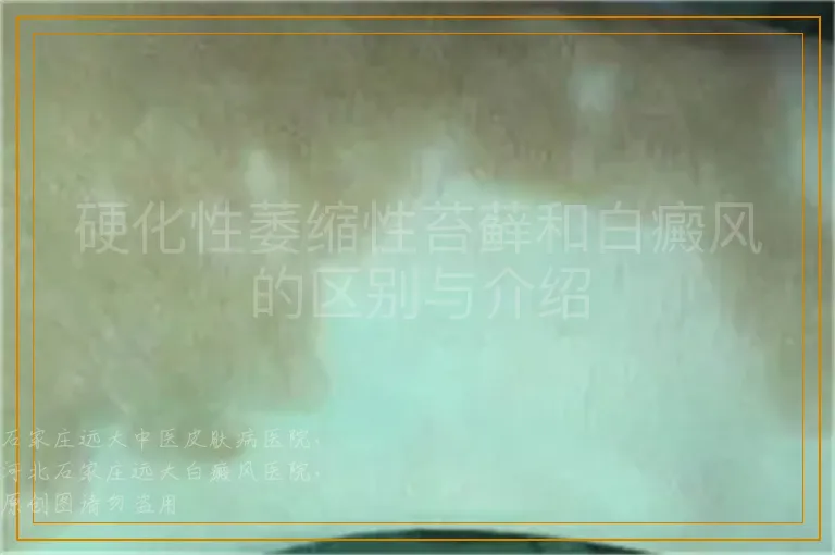 硬化性萎缩性苔藓和白癜风的区别与介绍