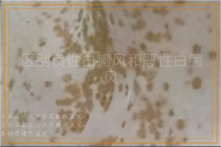 区别良性白癜风和恶性白癜风