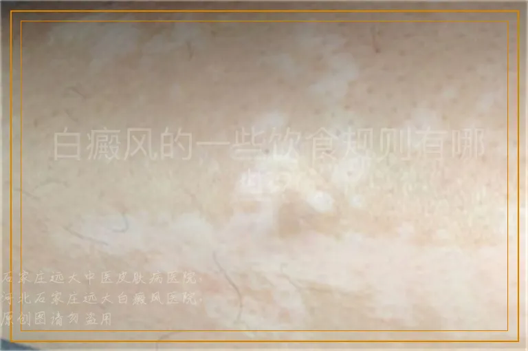 白癜风的一些饮食规则有哪些?