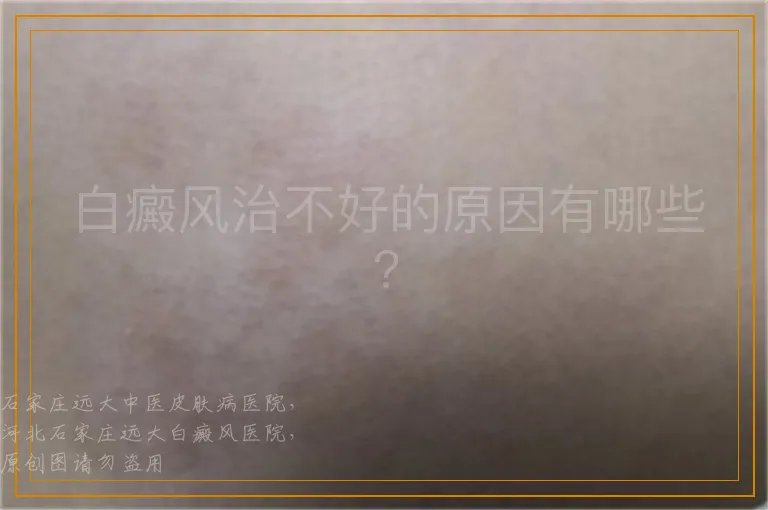 白癜风治不好的原因有哪些?