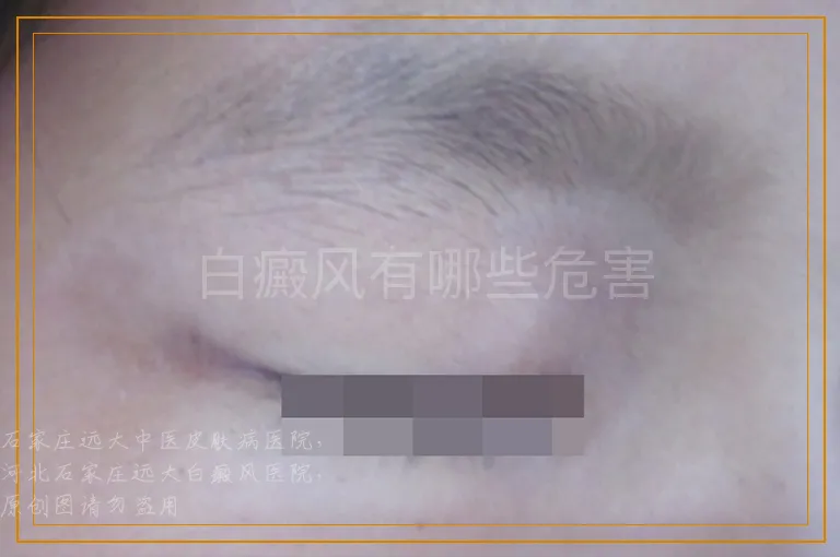 白癜风有哪些危害