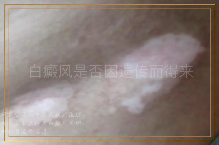 白癜风是否因遗传而得来