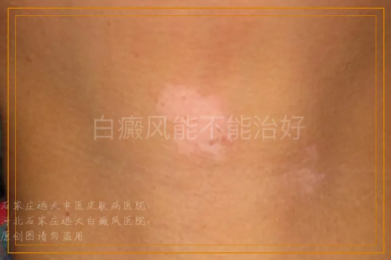 白癜风能不能治好