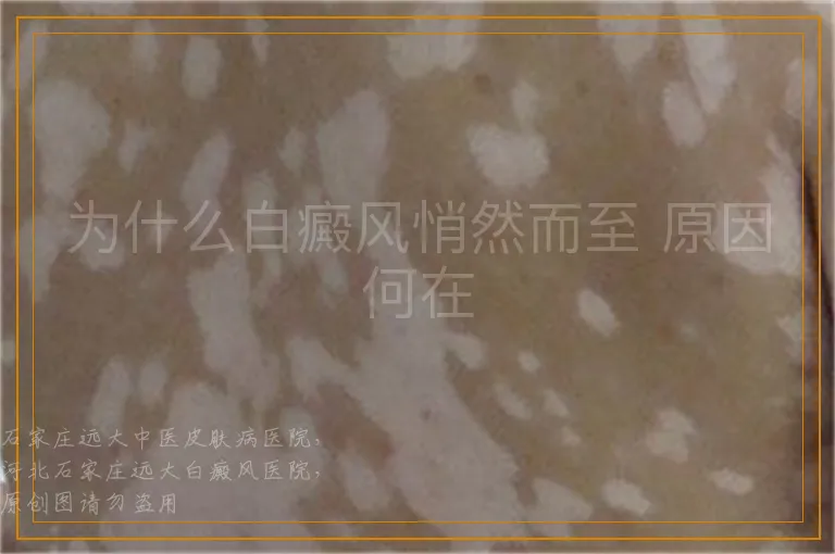 为什么白癜风悄然而至 原因何在