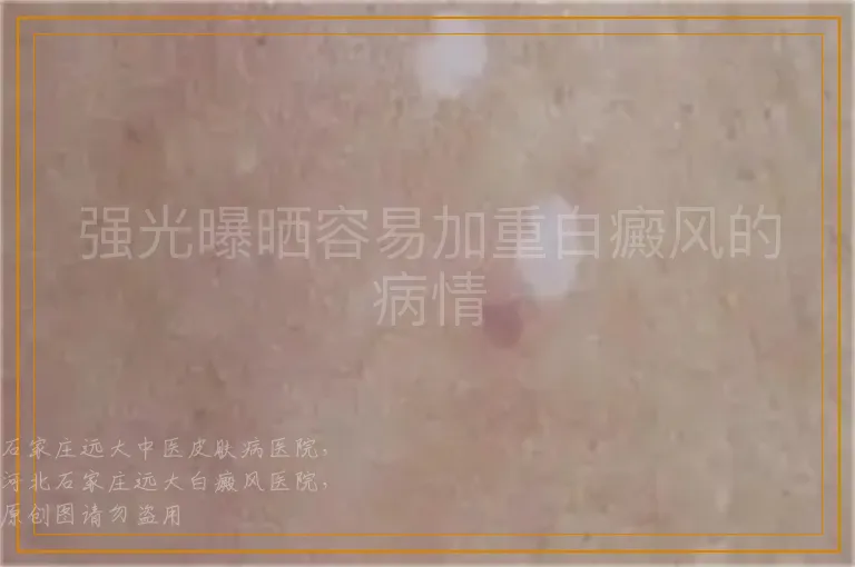 强光曝晒容易加重白癜风的病情