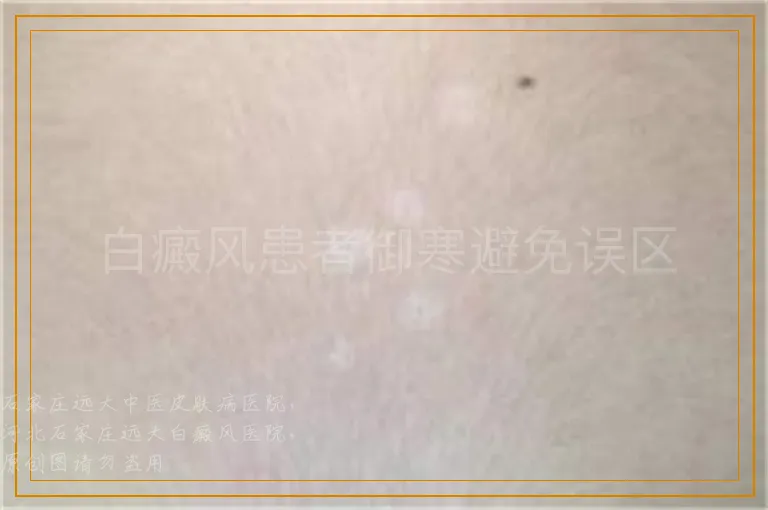 白癜风患者御寒避免误区