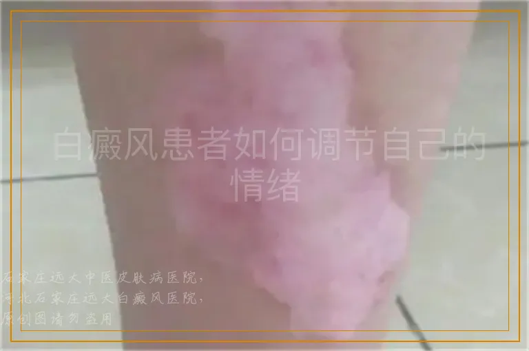 白癜风患者如何调节自己的情绪