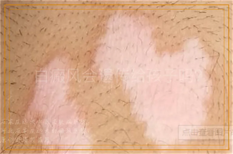 白癜风会遗传给孩子吗？