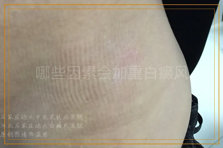 哪些因素会加重白癜风