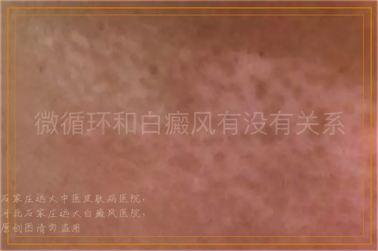 微循环和白癜风有没有关系