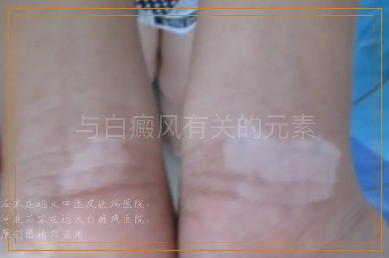 与白癜风有关的元素