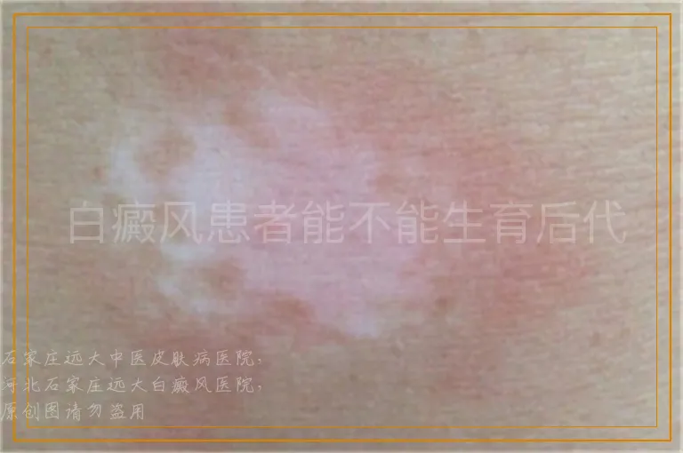 白癜风患者能不能生育后代