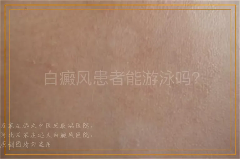 白癜风患者能游泳吗？