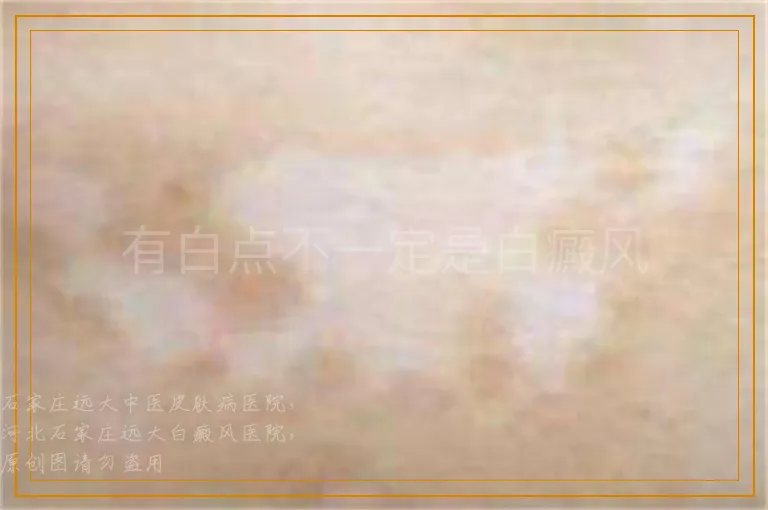 有白点不一定是白癜风