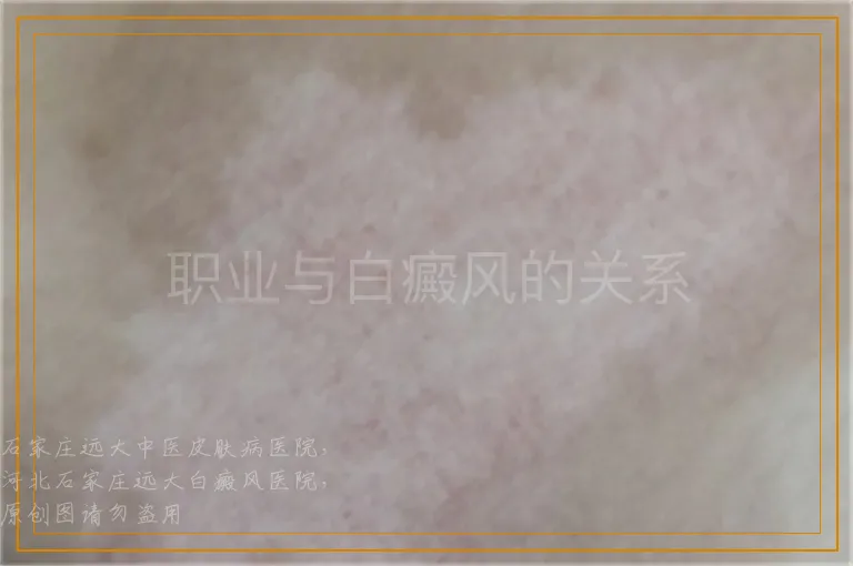 职业与白癜风的关系