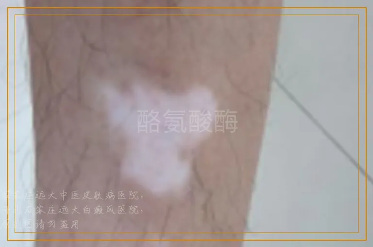 酪氨酸酶