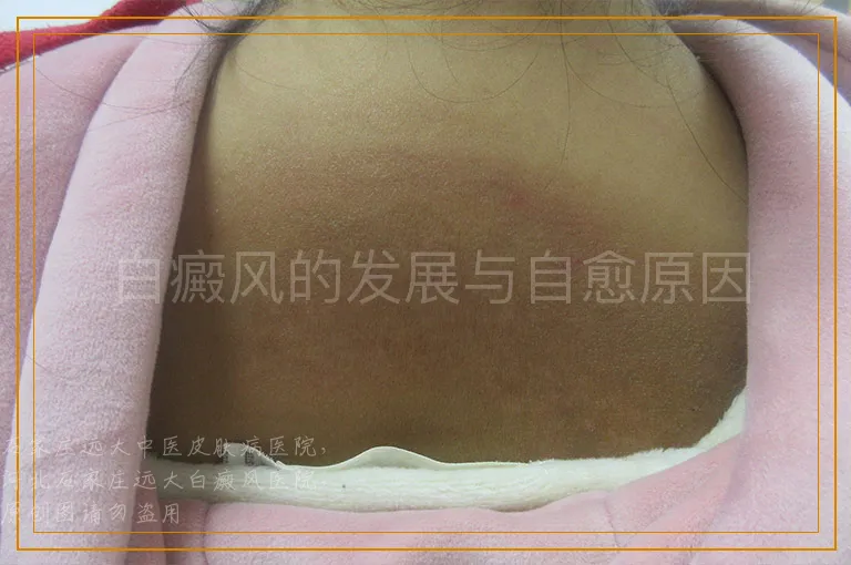 白癜风的发展与自愈原因