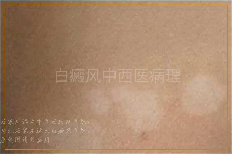 白癜风中西医病理