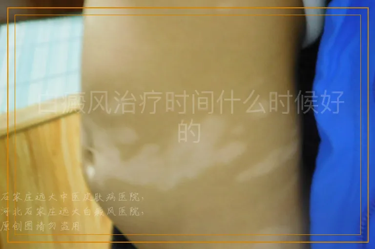 白癜风治疗时间什么时候好的