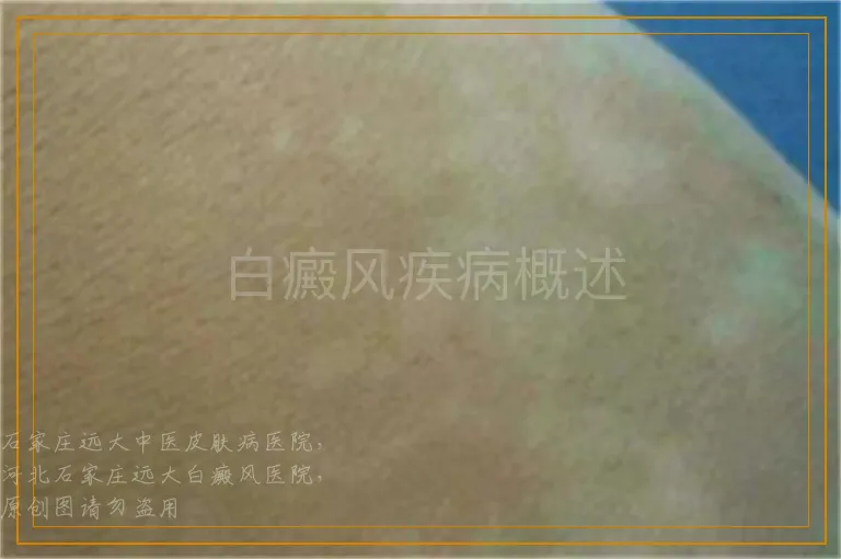 白癜风疾病概述