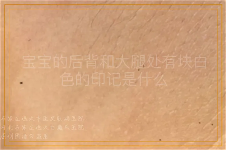 宝宝的后背和大腿处有块白色的印记是什么
