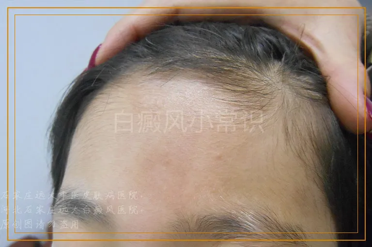 白癜风小常识