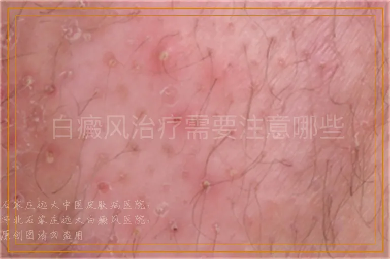 白癜风治疗需要注意哪些