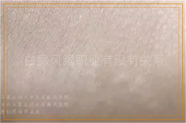 白癜风跟职业有没有关系