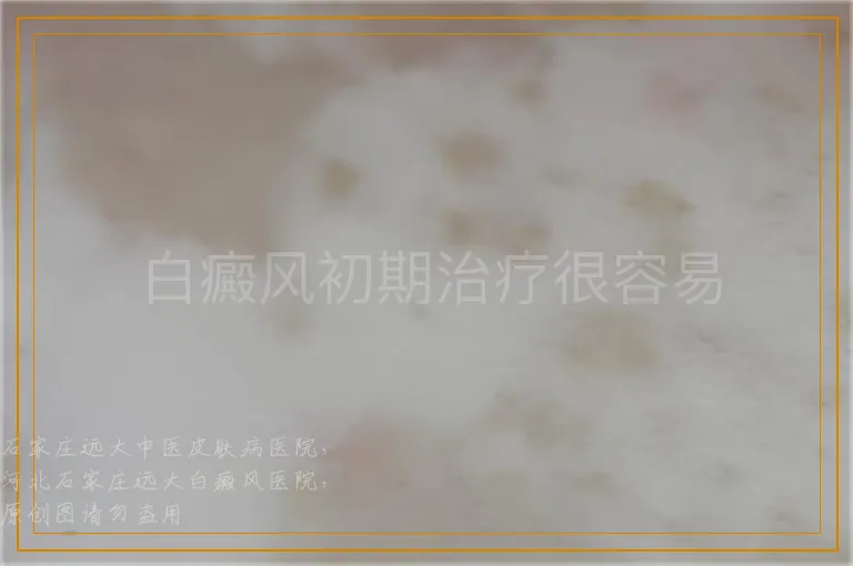 白癜风初期治疗很容易