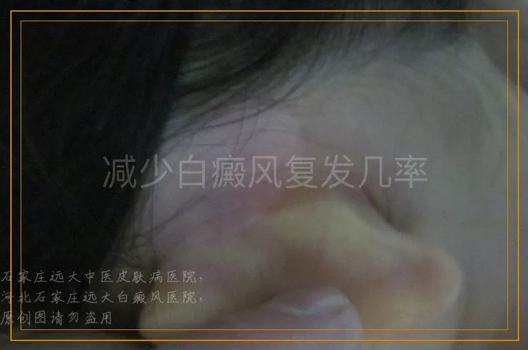 减少白癜风复发几率